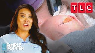 Most Satisfying Pops | Dr. Pimple Popper | TLC