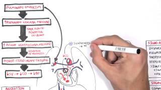 Pulmonary Embolism PART I (Overview)