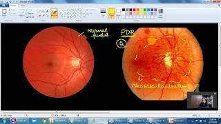 FMGE MCI examination: DIABETIC RETINOPATHY - Concepts & MCQs ;DR ANURADHA DHAWAN