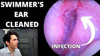 Swimmers Ear Cleaned With Suction (Outer Ear Infection)