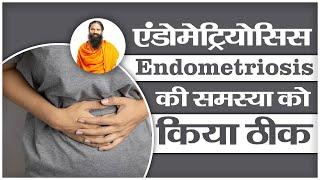 एंडोमेट्रियोसिस (Endometriosis) की समस्या को किया ठीक || Swami Ramdev