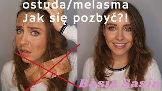 OSTUDA/MELASMA || Jak się pozbyć przebarwień?