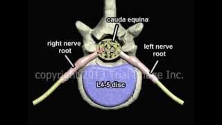 Bulging Disc - What Is It? - Animation and Narration by Cal Shipley, M.D.