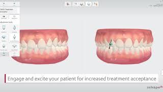 Go Beyond scanning with the 3Shape TRIOS Treatment Simulator