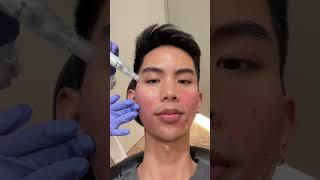 SHOCKING results from Microneedling!