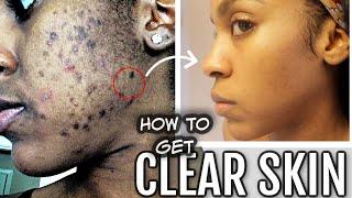 Do this Every Morning for CLEAR SKIN! | Get rid of Dark Scars (Hyperpigmentation) & Acne