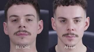 Dermal Fillers For Men