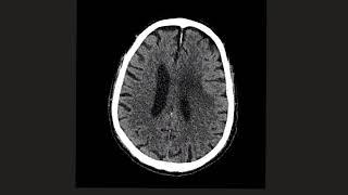 Intra-axial vs Extra-axial brain lesions: Can you tell the difference?