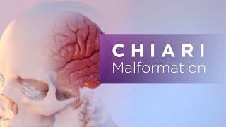 Chiari Malformation