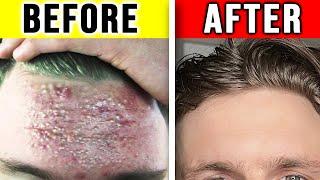 ELIMINATE BLACKHEADS & PREVENT THEM PERMANENTLY (FROM EXPERIENCE)