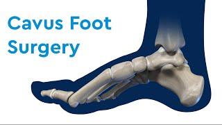 Cavus Foot Surgery and Recovery in Children