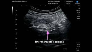 Modified subcostal QL block for postoperative analgesia - Supplementary video 1 [ID 306696]