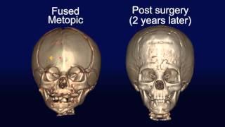 Metopic Synostosis