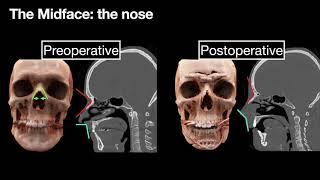 Facial Feminization Surgery: Key CT Findings for Preoperative Planning and Postoperative Evaluation