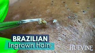 Removing Embedded Hairs From A Brazilian Laser Hair Removal #Showoff​ | HueVine