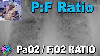 PaO2 to FiO2 Ratio - PF Ratio