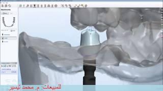 How to Design an Abutment with 3Shape Dental System