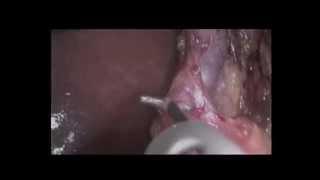 Laparoscopic Splenectomy for Splenic Artery Aneurysm in a Pregnant Patient