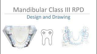 Mandibular Class III RPD Design: Step-by-Step Guide to Surveying & Drawing on Casts and Paper