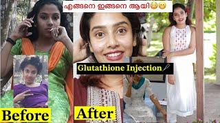 5 Years Fairness Cream Glutathione Injection 🩼എന്റെ മാറ്റത്തിന്റെ കാരണം #glamyganga