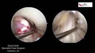 Acute Anterior Cruciate Ligament Injury