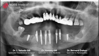 Clinical Case   Maxilla Reconstruction using Zygomatic Implants  By Dr  L  Yehuda Gil, Specialist Ma