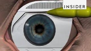 How LASIK Eye Surgery Is Performed