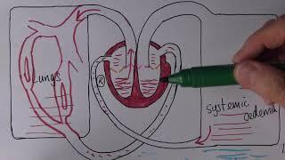 Heart Failure 4, Causes of right ventricular failure