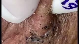 Satisfying pimple popping and black heads extraction from skin