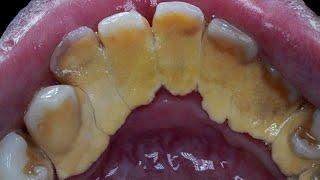 32 YO. MALE'S TEETH | SCALING | TARTAR REMOVAL | DENTIST | Dokter Gigi Tri Putra