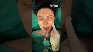 Revolutionary Scarless Facelift Transformation by Dr. Suleyman Tas