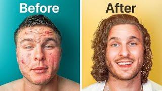 How I FINALLY Got Rid of My Acne!