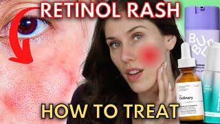 Do You Have A Retinol Rash Or Are You Experiencing Retinization?