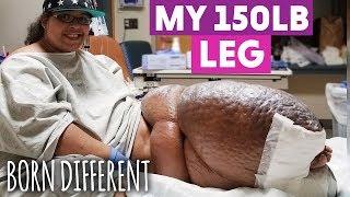 The Woman With The 150lb Leg | BORN DIFFERENT