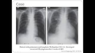 HIV and TB Treatment