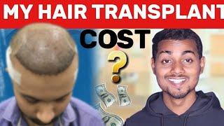 My Hair Transplant Cost | Hair Transplant Cost in India | FUE Hair Transplant Cost