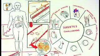 Advanced Glycosylation End Products and Diabeteic complications