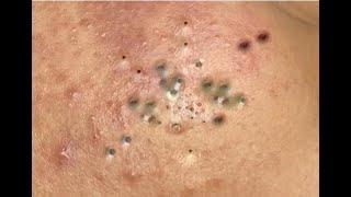 Shocking Cystic Blackheads & Whiteheads Extraction Revealed / new blackheads this week 12-18