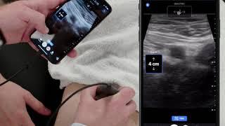 Ultrasound Education: The Femoral Vein