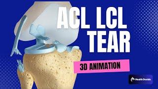 Watch How ACL LCL Tears Are Repaired - 3d Animation Explained