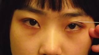 #ChaseLayMD Suture Technique Asian Eyelid Surgery