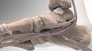 Flatfoot Repair With the InternalBrace™ Ligament Augmentation Procedure