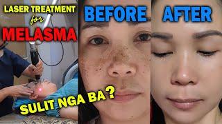 MELASMA LASER TREATMENT IN KOREA | EFFECTIVE NGA BA | AJ PAKNERS