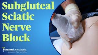 Subgluteal Sciatic Nerve Block