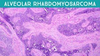 Alveolar rhabdomyosarcoma (explained in 5 minutes) (pediatric pathology USMLE rare disease)
