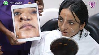 Cleft Rhinoplasty: Consultation and Post-Op  - Dr. Sunil Richardson | Richardsons Face Hospitals