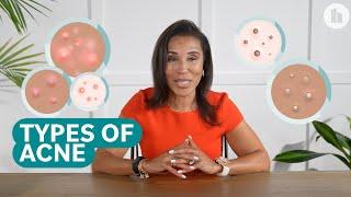 The Different Types of Acne and How to Treat Them