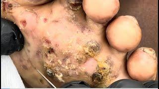 Jigger removal, chigger removal, sandflea removal satisfying cyst and boil popping compilation