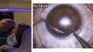 London Vision Clinic | ReLEx SMILE | Live laser eye surgery | Professor Dan Reinstein