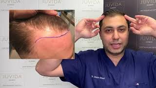 Hair Transplant Case Study | Juvida Clinics